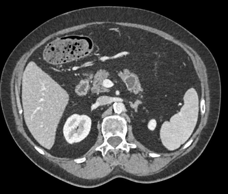 Intraductal Papillary Mucinous Neoplasm (IPMN) Pancreas - CTisus CT Scan