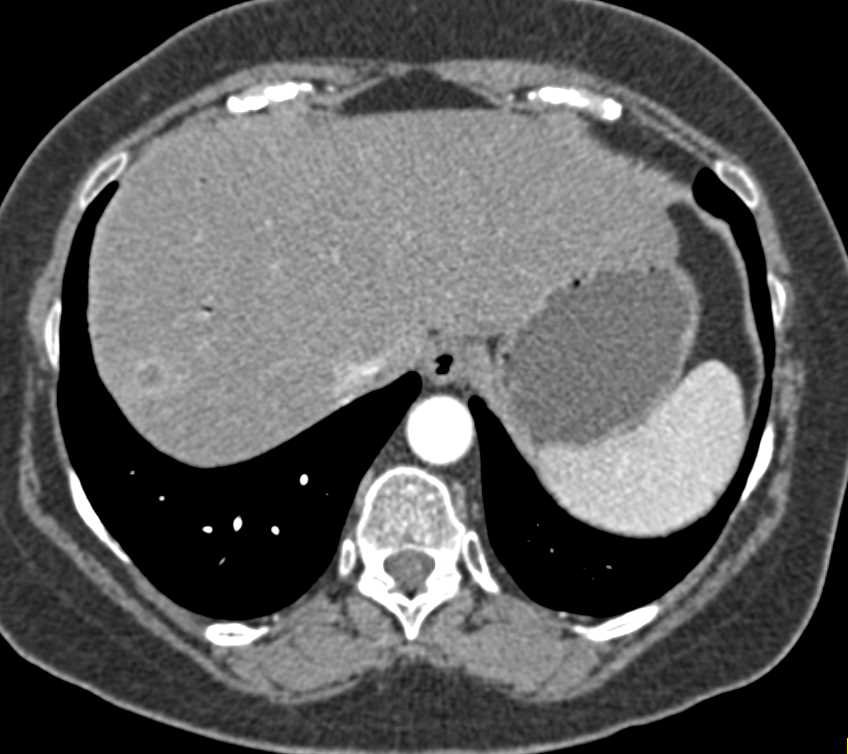 Pancreatic Cancer with Liver Metastases - CTisus CT Scan