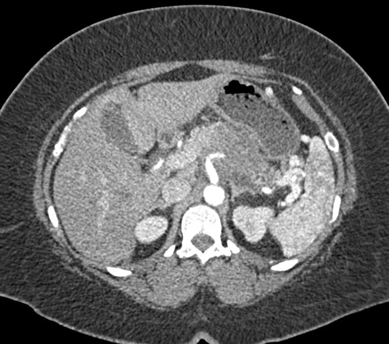 Pancreatic Cancer with Vascular Invasion - CTisus CT Scan