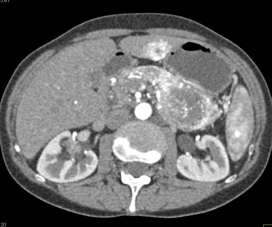 Neuroendocrine Tumor Tail of pancreas with Vascular Liver Metastases - CTisus CT Scan
