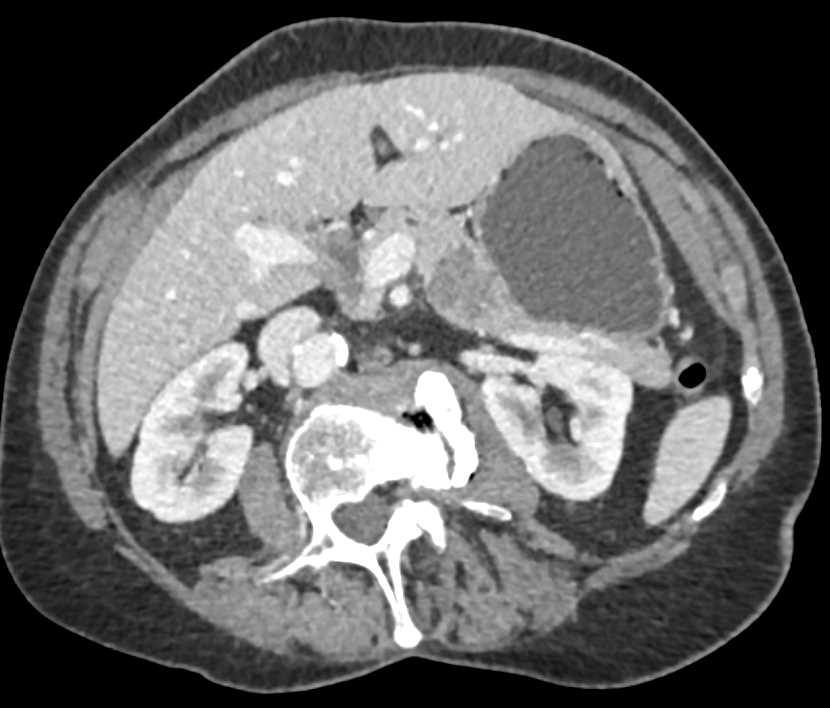 Carcinoma Body of the Pancreas - CTisus CT Scan