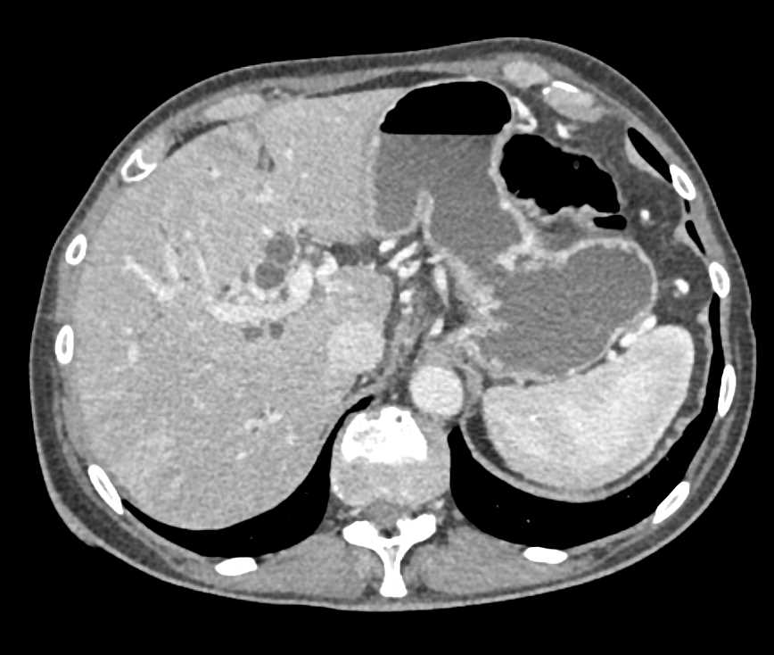Pancreatic Adenocarcinoma with Vascular Encasement on Arterial and Venous Structures - CTisus CT Scan