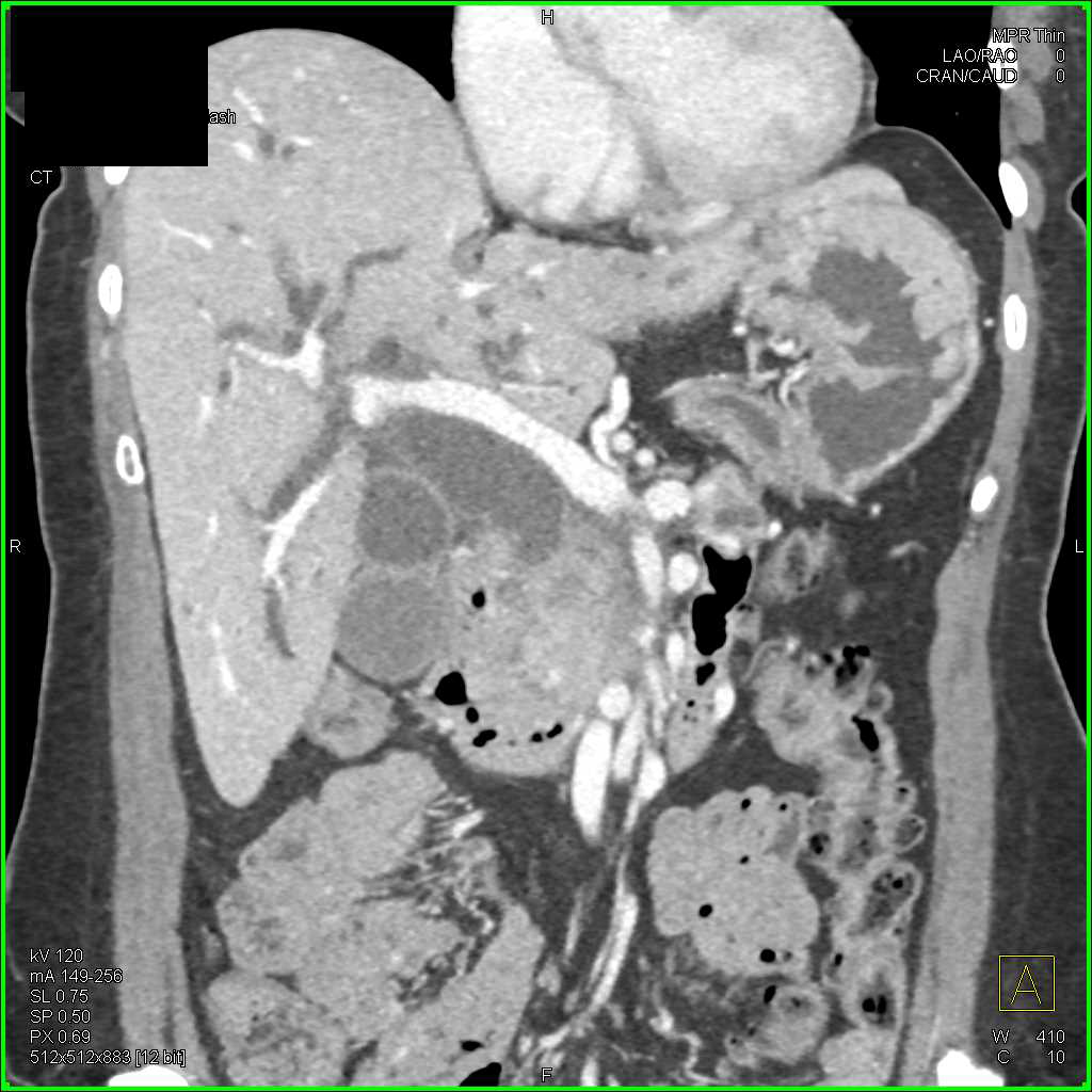 Pancreatic Cancer Obstructs the Common Bile Duct - CTisus CT Scan