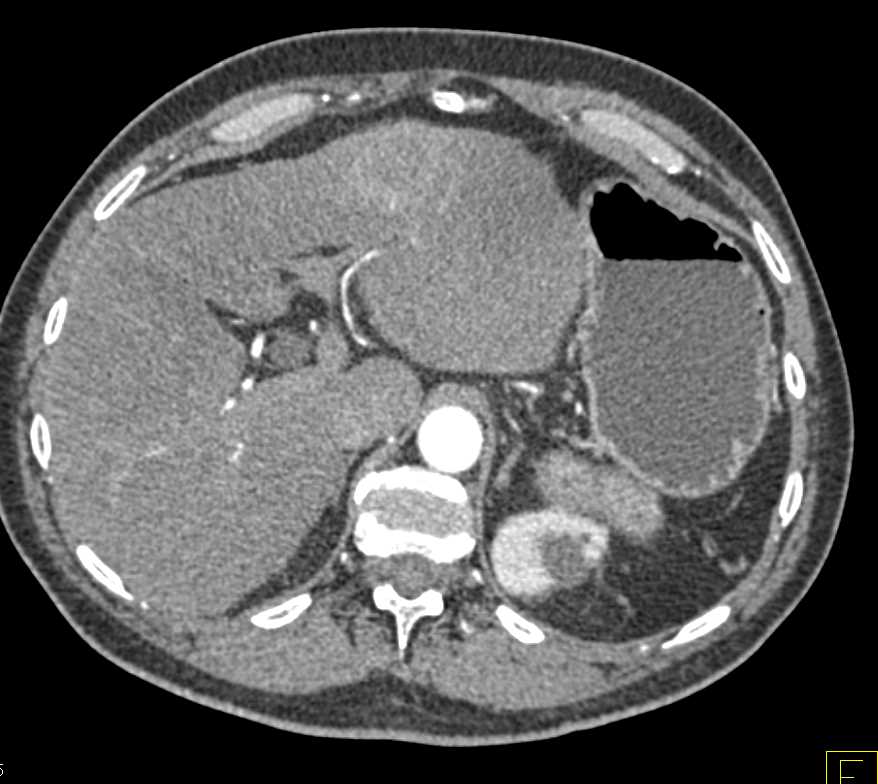 Invasive Pancreatic Cancer with Vascular Invasion - CTisus CT Scan