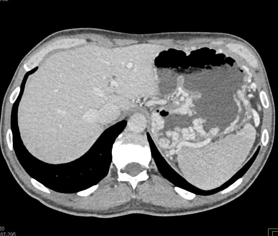 Carcinoma Tail of Pancreas with Vascular Varices from Liver - CTisus CT Scan