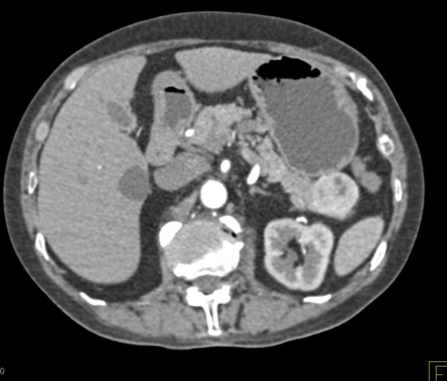 Neuroendocrine Tumor Tail of the Pancreas - CTisus CT Scan