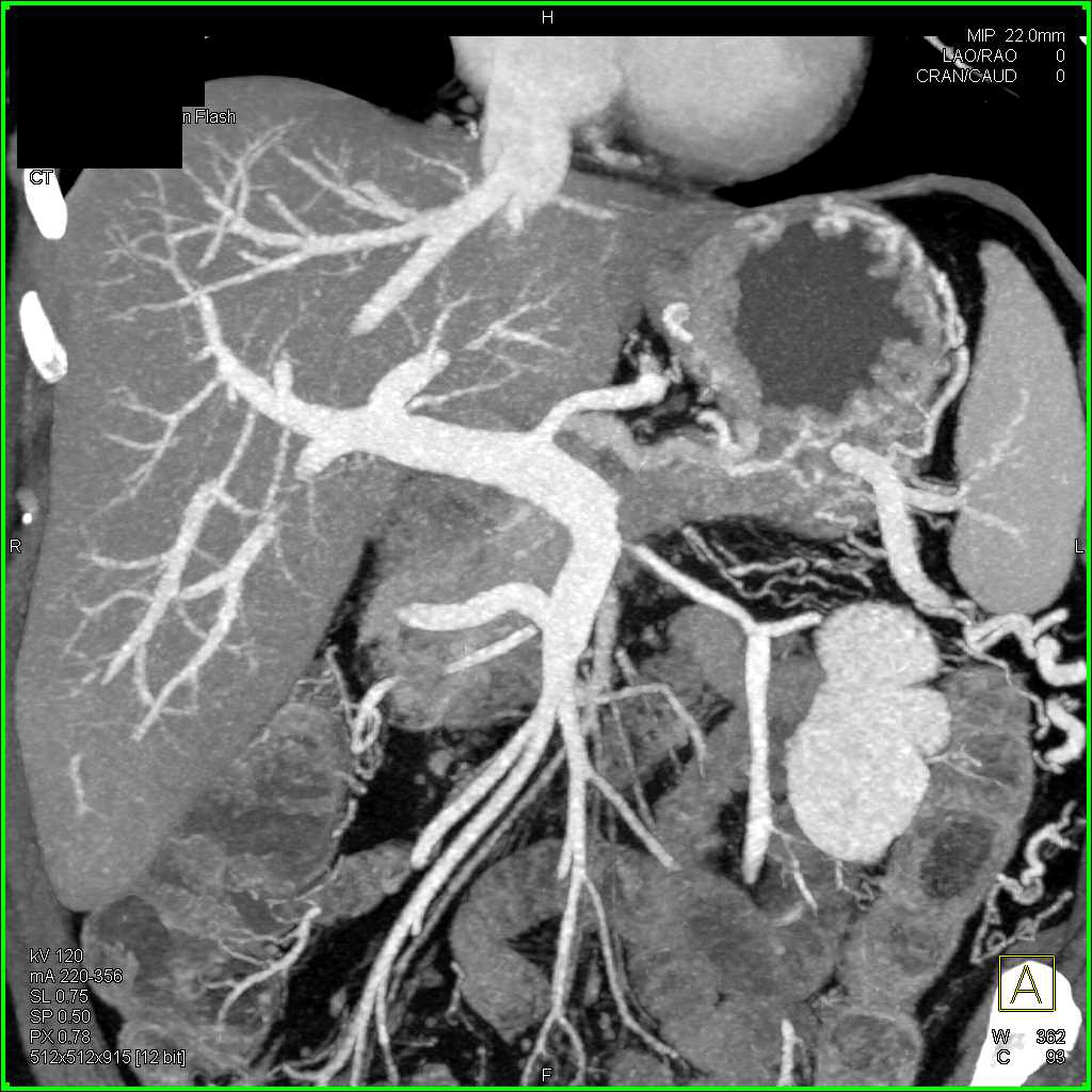 Pancreatic Cancer Occludes the Splenic Vein - CTisus CT Scan