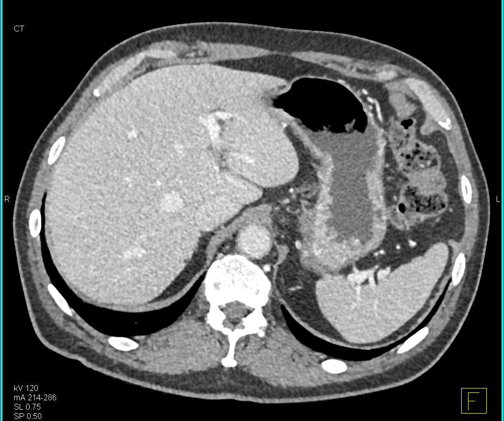 Insulinoma 1 cm Tail of Pancreas - CTisus CT Scan