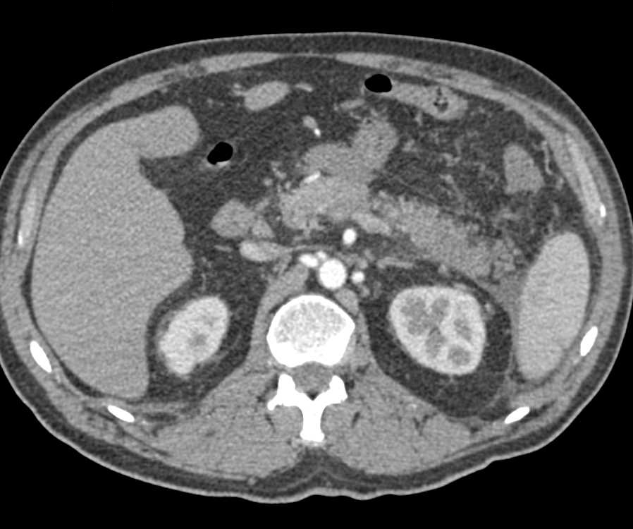 Acute Pancreatitis with Inflammation Tail of the Pancreas - CTisus CT Scan