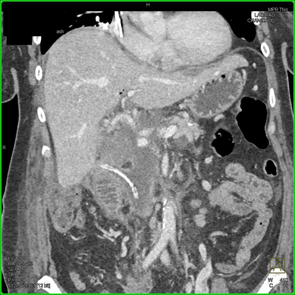 Inflammatory Changes Post Whipple Procedure - CTisus CT Scan