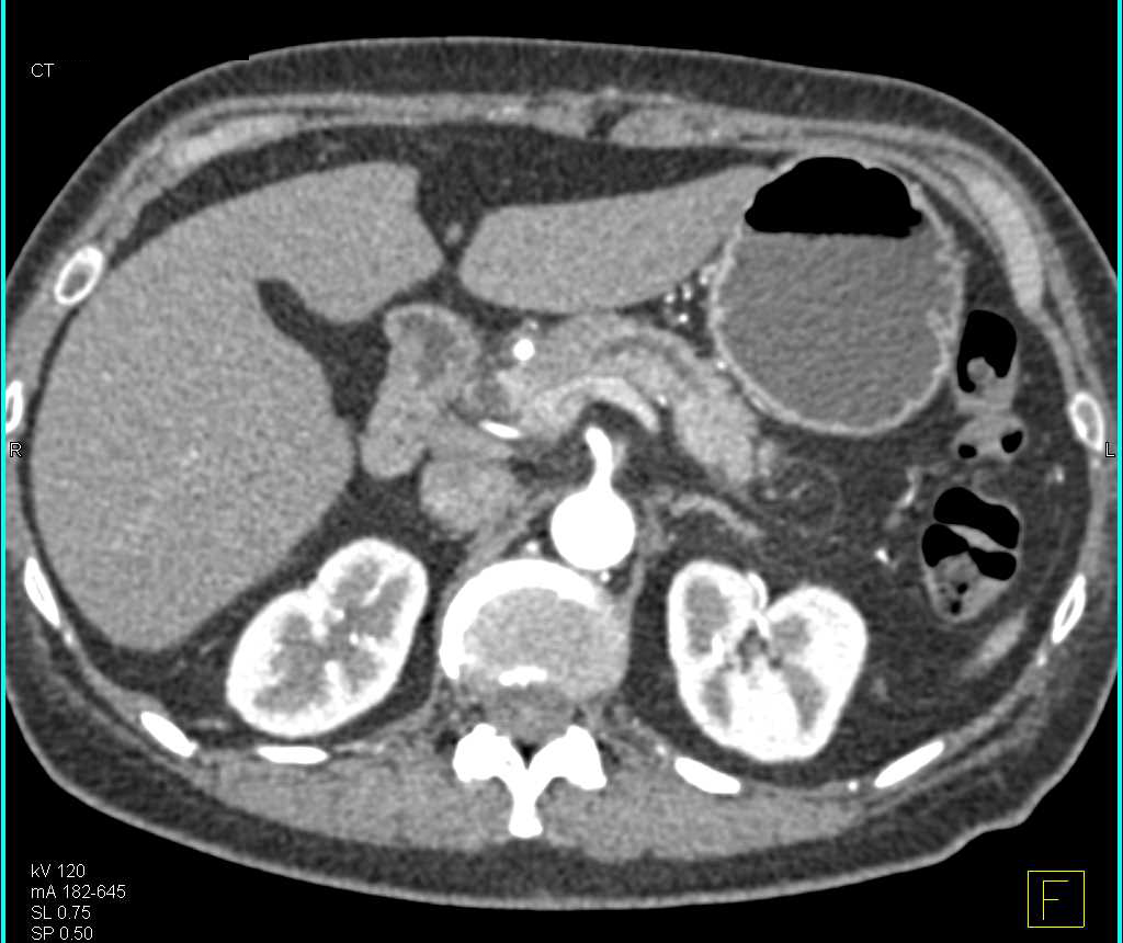 Carcinoma of the Body of the Pancreas - CTisus CT Scan