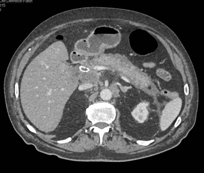 Autoimmune Pancreatitis - CTisus CT Scan