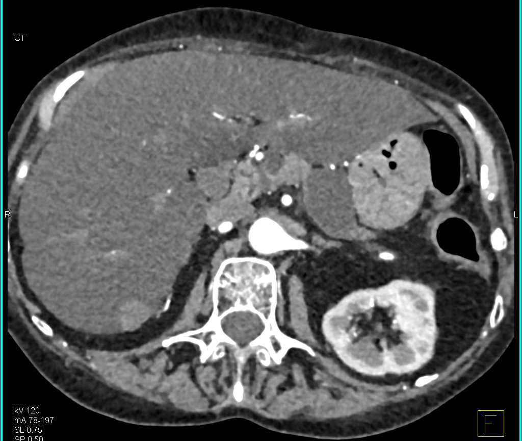 Mucinous Cystic Neoplasm (MCN) Body of the Pancreas - CTisus CT Scan