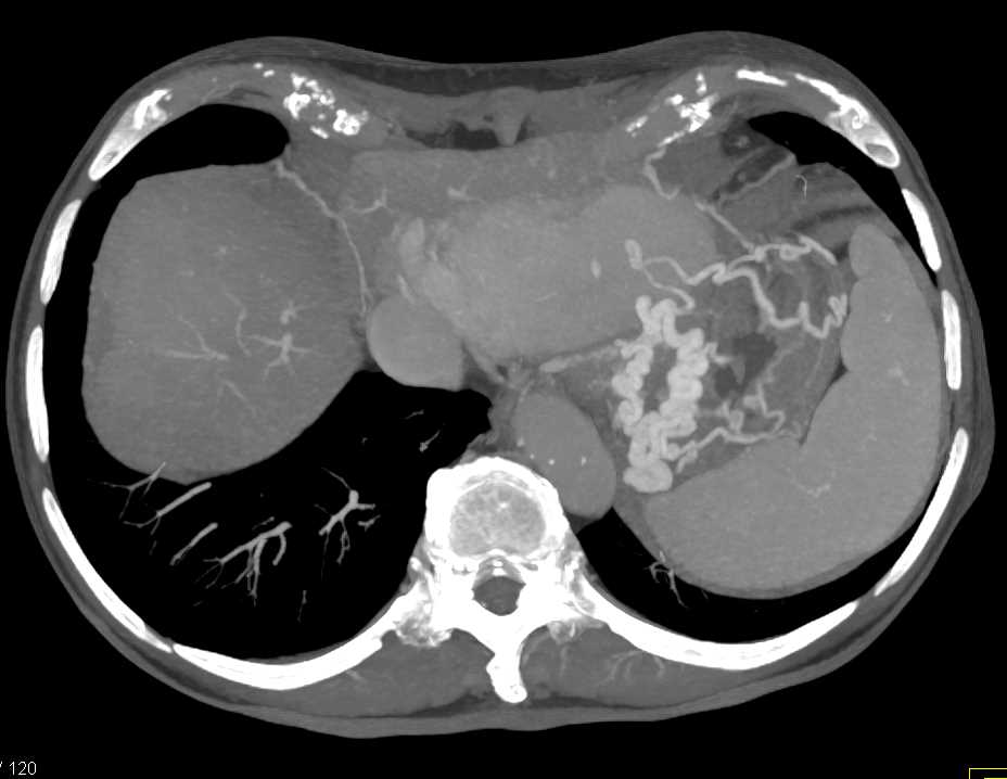 Pancreatic Cancer Occludes the Splenic Vein with Extensive Collaterals - CTisus CT Scan