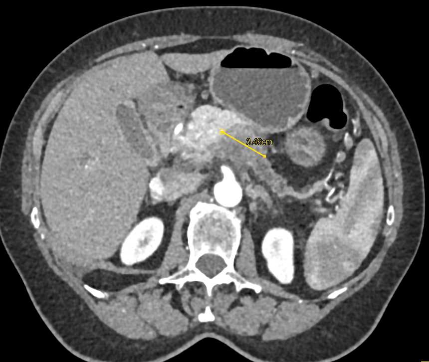 Adenocarcinoma Body of the Pancreas with Vascular Encasement - CTisus CT Scan