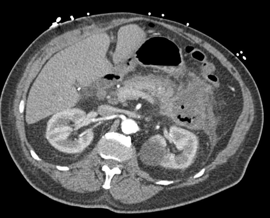 Acute Pancreatitis with Pancreatic Necrosis - CTisus CT Scan