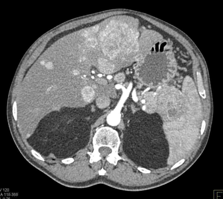 Neuroendocrine Tumor in the Tail of the Pancreas with Vascular Liver Metastases - CTisus CT Scan