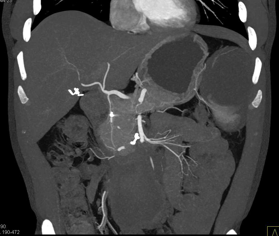 Carcinoma Head of the Pancreas - CTisus CT Scan