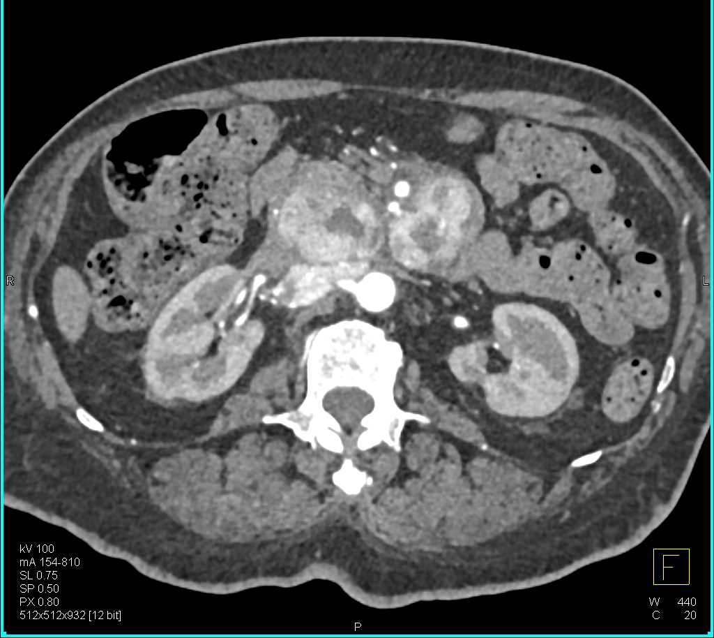 Pancreatic Neuroendocrine Tumor - CTisus CT Scan
