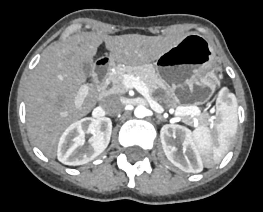 Carcinoma Tail of Pancreas Arises from an Intraductal Papillary Mucinous Neoplasm (IPMN) - CTisus CT Scan