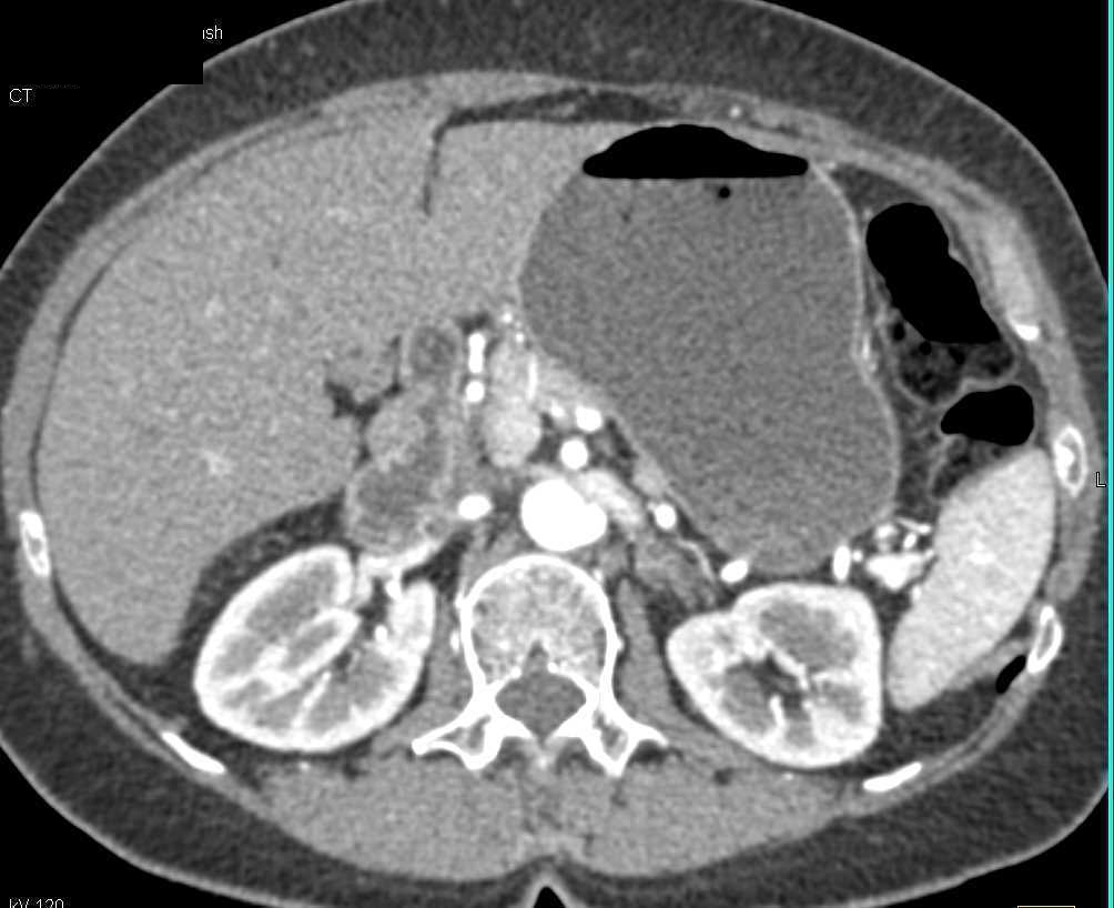 Carcinoma of the Pancreas - CTisus CT Scan