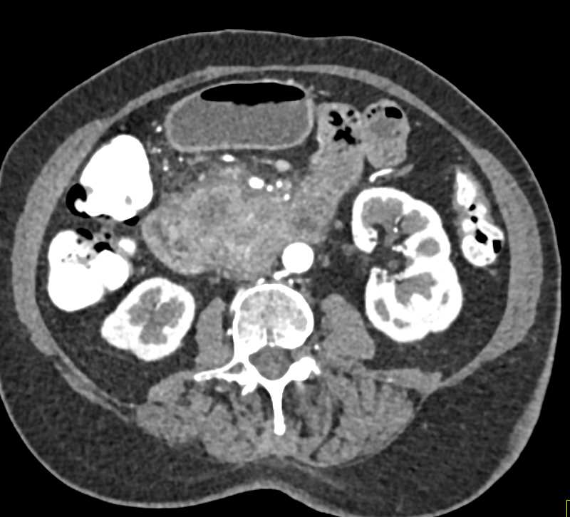 Pancreatic Cancer with Superimposed Pancreatitis - CTisus CT Scan