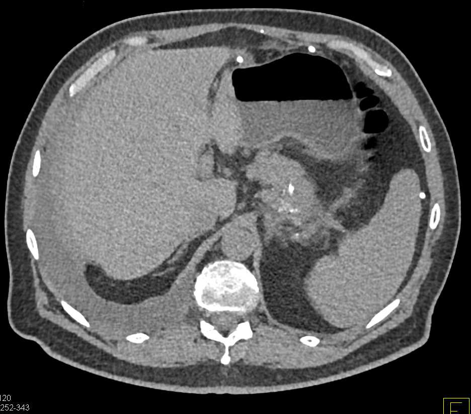 Carcinoma Tail of Pancreas with Carcinomatosis - CTisus CT Scan