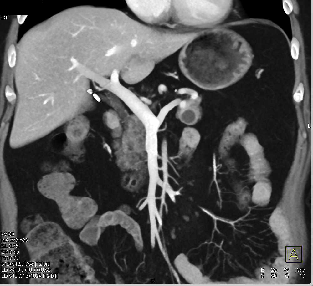 Ampullary Carcinoma Obstructs the Common Bile Duct (CBD) - CTisus CT Scan