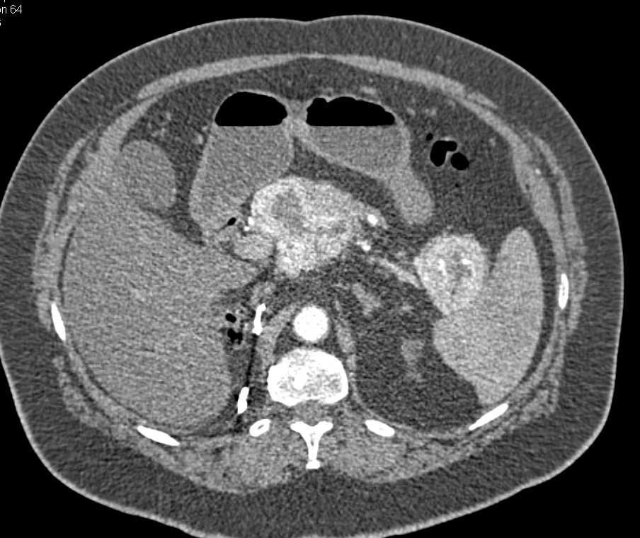 Renal Cell Carcinoma Metastatic to the Pancreas - CTisus CT Scan