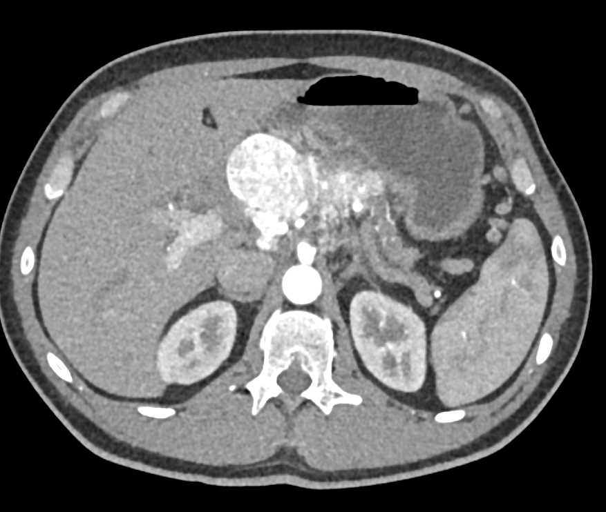 Neuroendocrine Tumor of the Pancreas with Venous Involvement - CTisus CT Scan