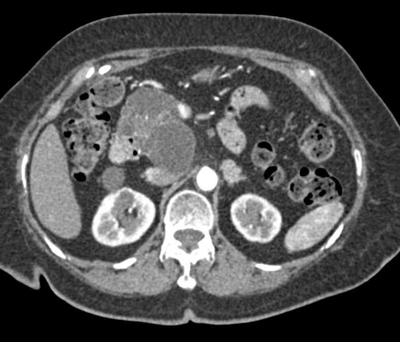 Serous Cystadenoma Pancreas - CTisus CT Scan