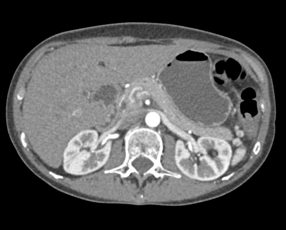 Multiple Splenules by the Tail off the Pancreas - CTisus CT Scan