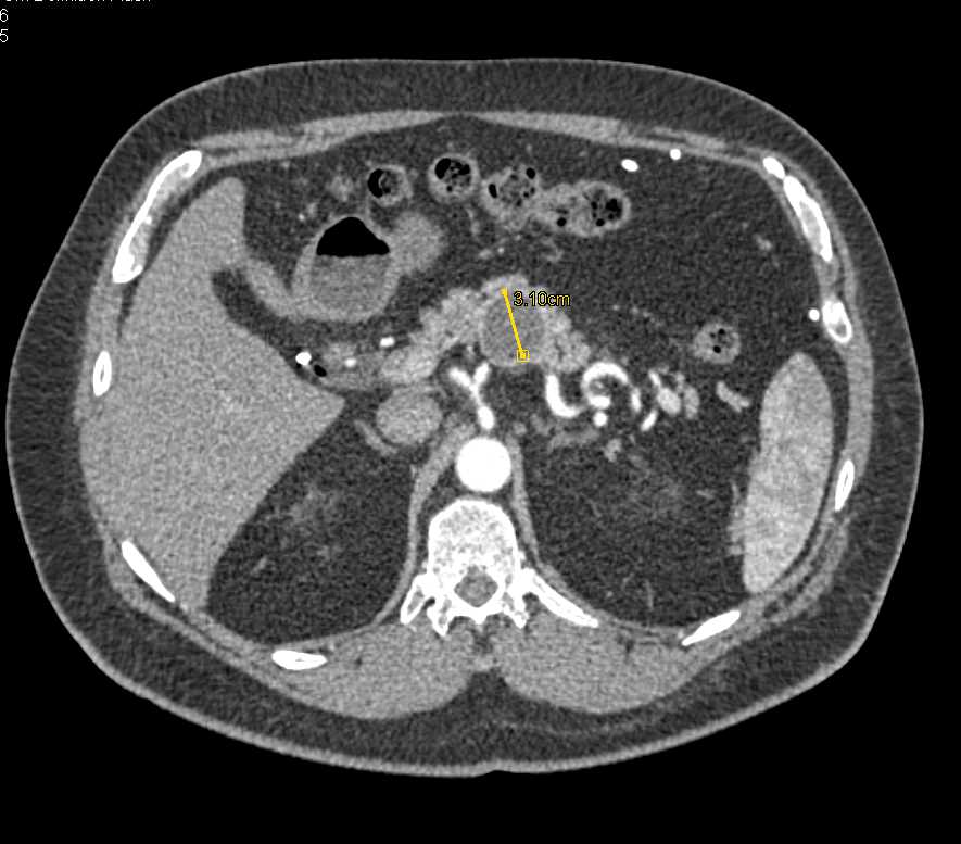 Mucinous Cystic Neoplasm (MCN) Body of Pancreas - CTisus CT Scan