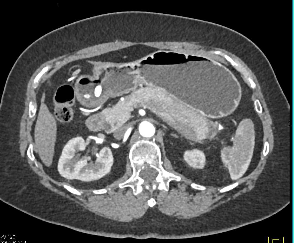 Autoimmune Pancreatitis - CTisus CT Scan