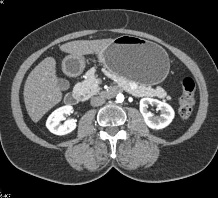 1cm Neuroendocrine Tumor Body of Pancreas - CTisus CT Scan
