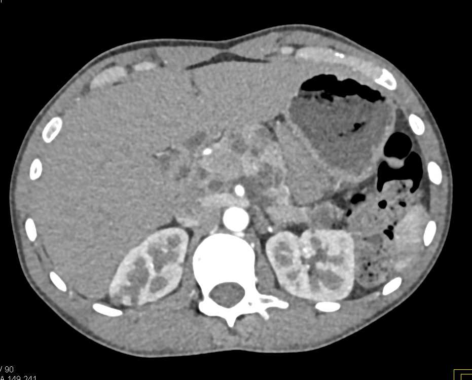 Multiple Intraductal Papillary Mucinous Neoplasms (IPMNs) and Multiple Renal Cysts - CTisus CT Scan