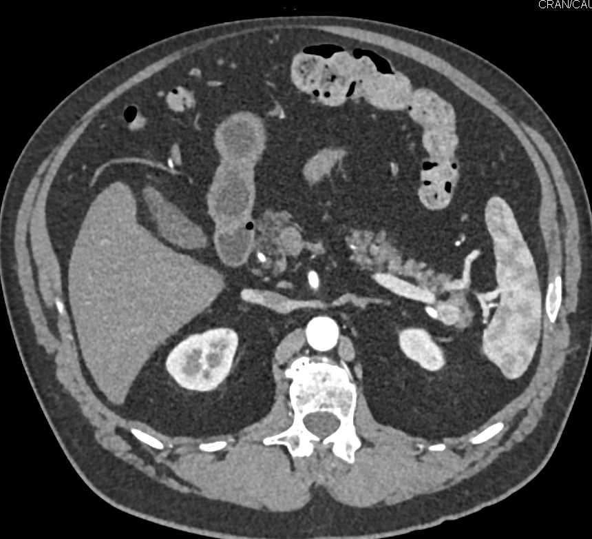 Splenule Near Tail of Pancreas Simulates a Pancreatic Neuroendocrine Tumor (PNET) - CTisus CT Scan