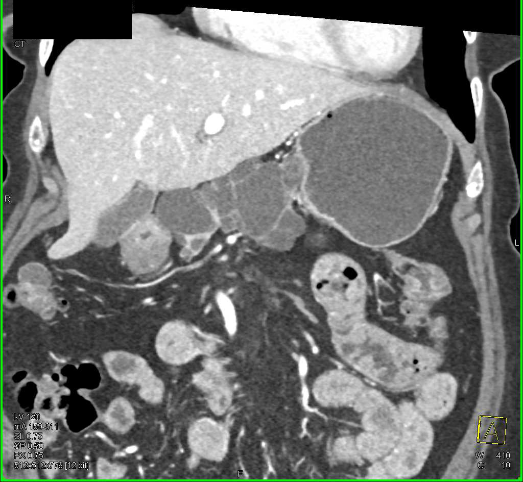 Multiple Intraductal Papillary Mucinous Neoplasms (IPMNs) in the Pancreas - CTisus CT Scan