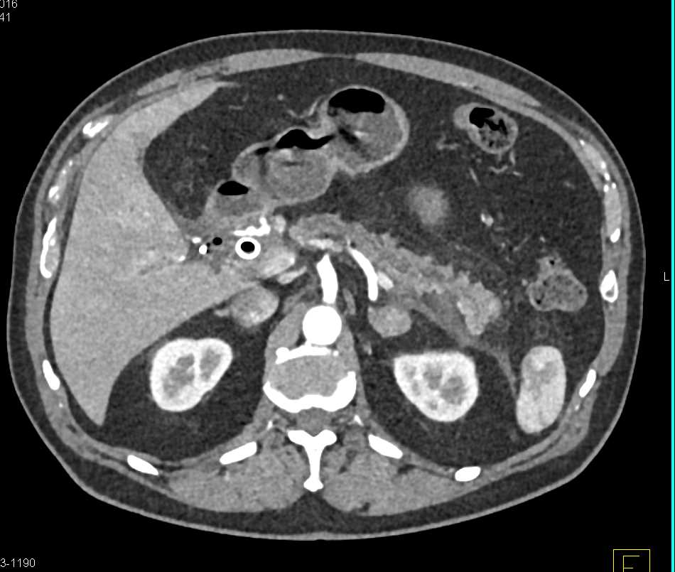 Carcinoma Head of the Pancreas - CTisus CT Scan