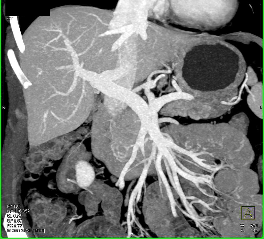 Carcinoma Head of the Pancreas - CTisus CT Scan