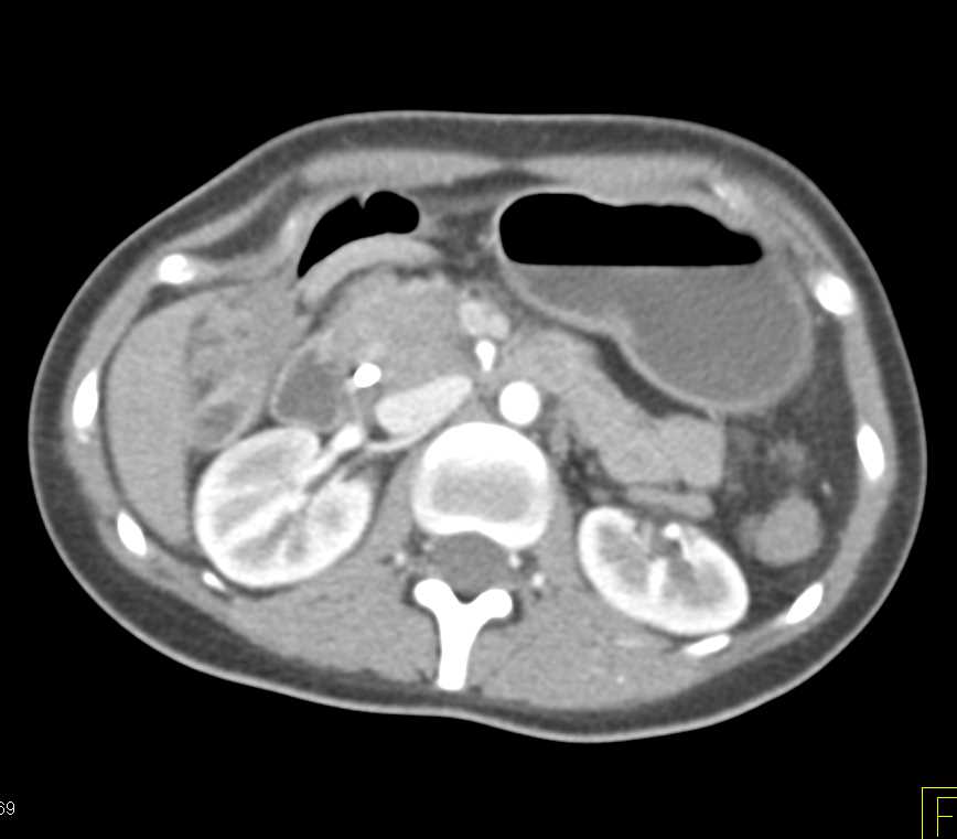 Pancreatic Cancer in the Head of the Pancreas - CTisus CT Scan