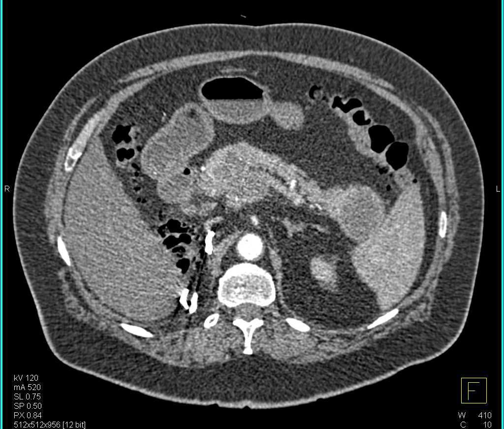 Metastatic Renal Cell Carcinoma to the Pancreas - CTisus CT Scan