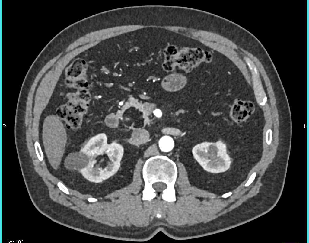 Lipoma Pancreatic Head and Intraductal Papillary Mucinous Neoplasms (IPMNs) Tail of Pancreas - CTisus CT Scan