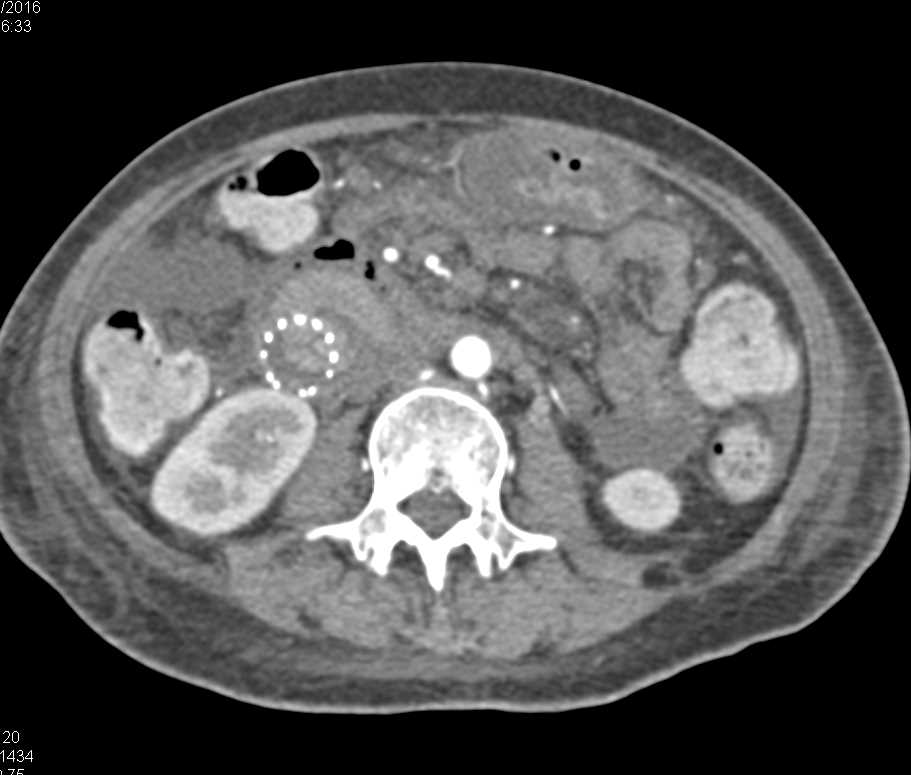 Pancreatic Cancer Invades the Duodenum - CTisus CT Scan
