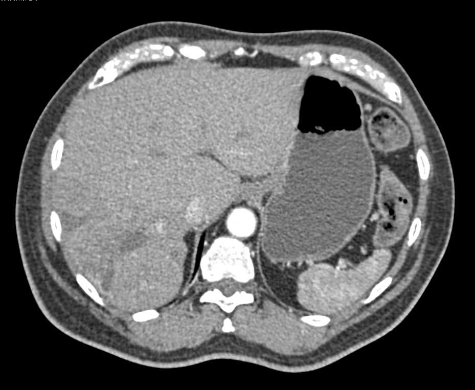 Neuroendocrine Tumor Pancreas with Liver Metastases - CTisus CT Scan