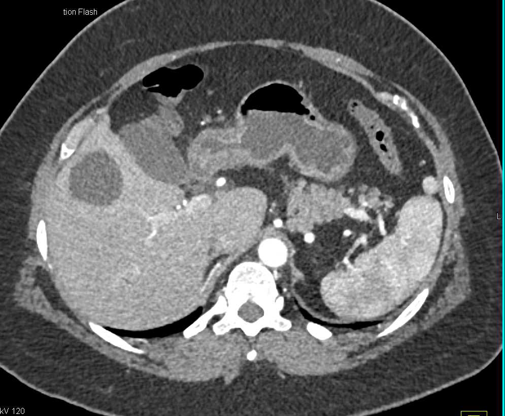 Carcinoma in the Head of the Pancreas - CTisus CT Scan