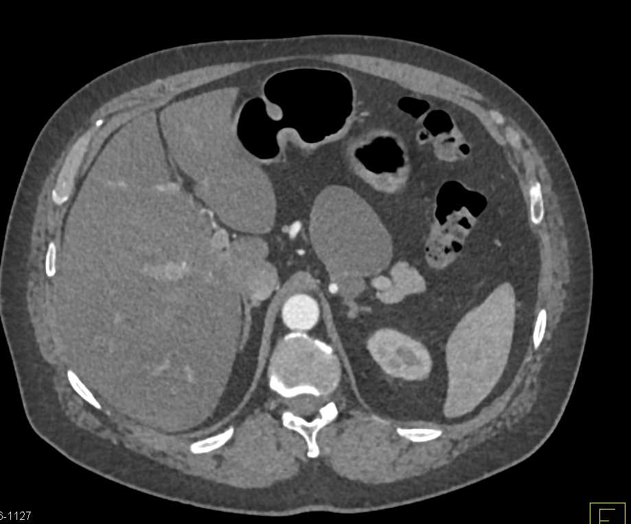 Lymphoepithelial Cyst Pancreas - CTisus CT Scan
