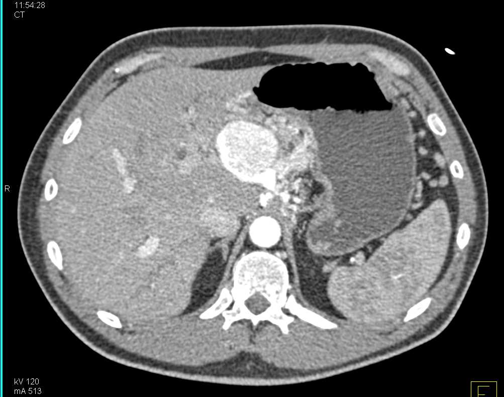 Pancreatic Neuroendocrine Tumor (PNET) Pancreas with PV Thrombosis - CTisus CT Scan