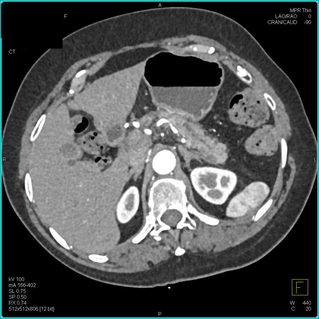 Pancreatic Adenocarcinoma Obstructs the Pancreatic Duct - CTisus CT Scan