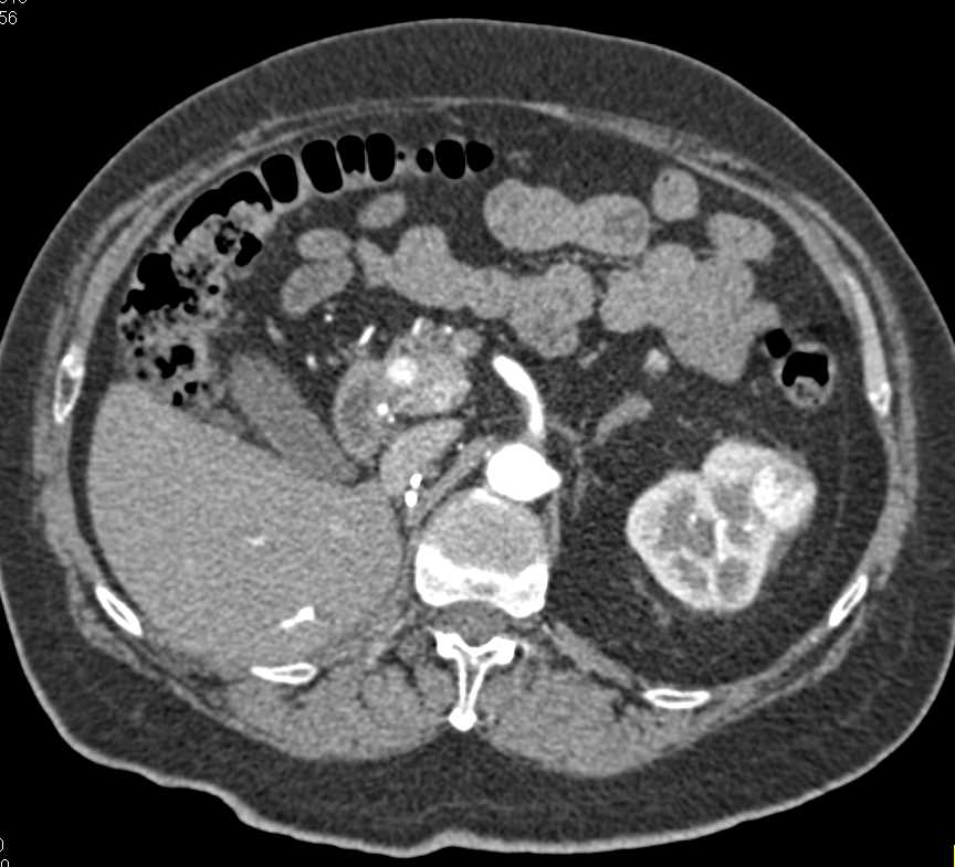 Metastatic Renal Cell Carcinoma to the Pancreas - CTisus CT Scan